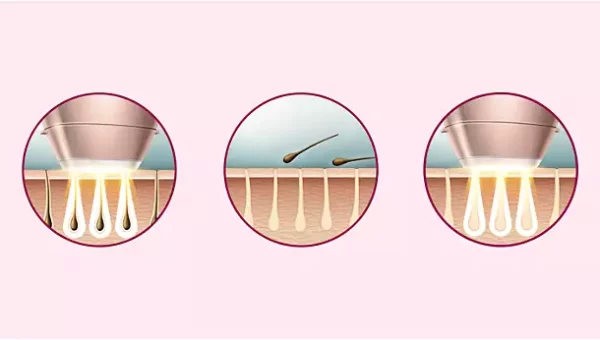 lumea 1 Philips Lumea IPL Hair Removal Device BRI944/00