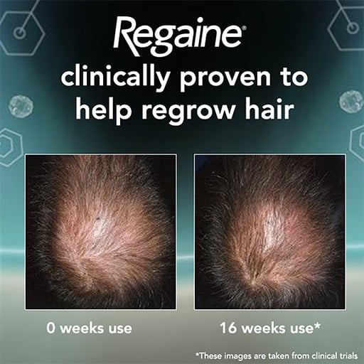 clincal_trials ROGAINE / REGAINE® FOR MEN EXTRA STRENGTH SCALP FOAM
