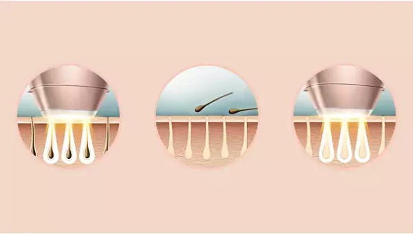 lumea 949 12 Philips Lumea Prestige IPL Hair Removal Device BRI949